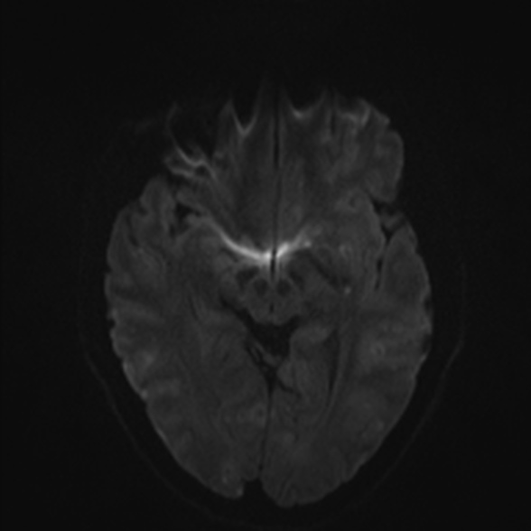 Cerebral toxoplasmosis (Radiopaedia 53993-60132 Axial DWI 39).jpg
