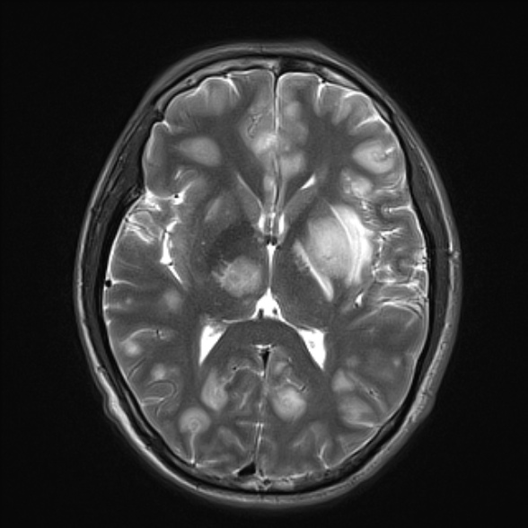 File:Cerebral toxoplasmosis (Radiopaedia 53993-60132 Axial T2 14).jpg