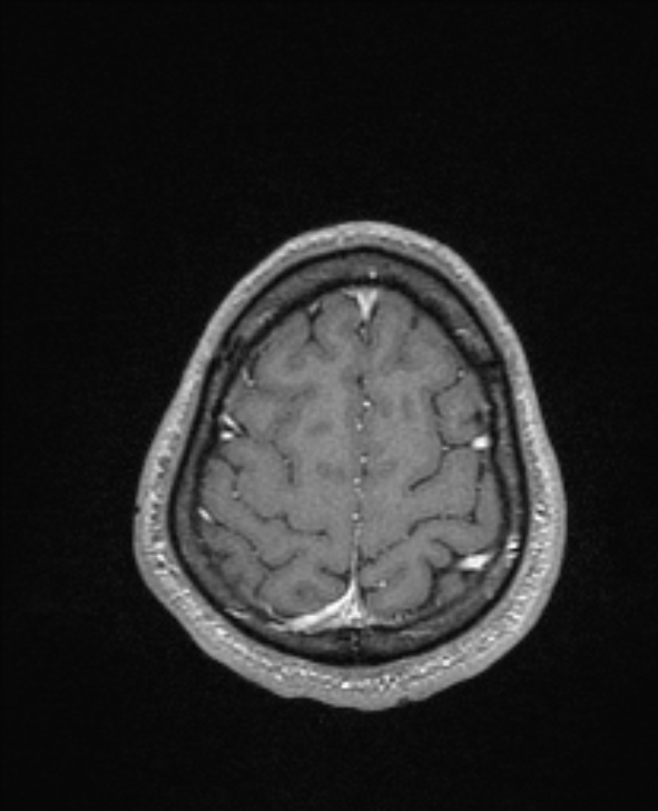 Cerebral toxoplasmosis (Radiopaedia 85779-101597 Axial T1 C+ 140).jpg