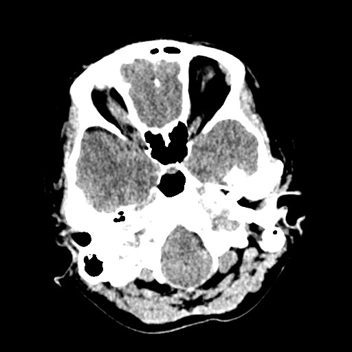 Cerebral tuberculosis with dural sinus invasion (Radiopaedia 60353-68018 Axial non-contrast 8).jpg