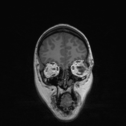 Cerebral tuberculosis with dural sinus invasion (Radiopaedia 60353-68090 Coronal T1 42).jpg