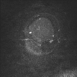 Cerebral tuberculosis with dural sinus invasion (Radiopaedia 60353-68090 Sagittal MRV 5).jpg