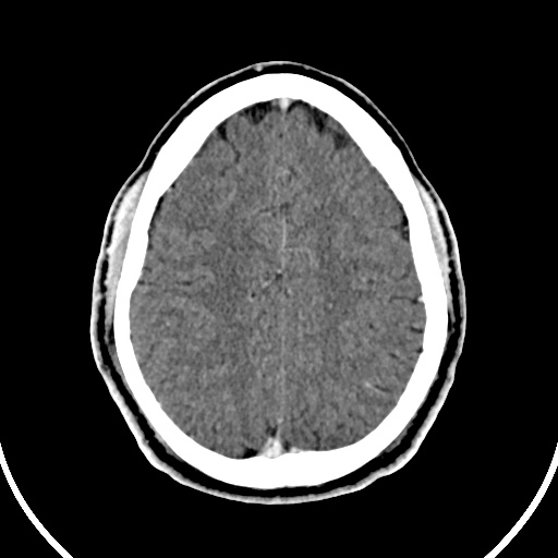 File:Cerebral venous angioma (Radiopaedia 69959-79977 B 75).jpg