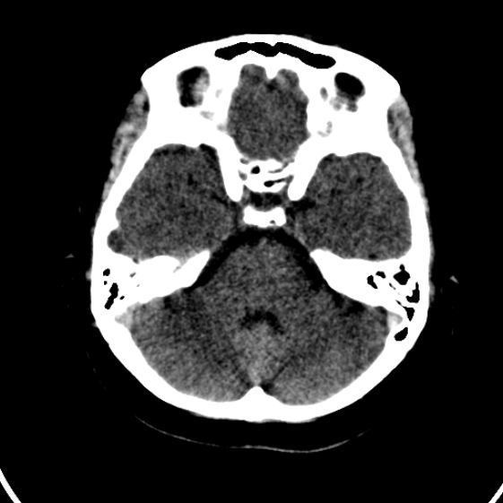 File:Cerebral venous hemorrhagic infarct from venous sinus thrombosis (Radiopaedia 55433-61879 Axial non-contrast 6).jpg