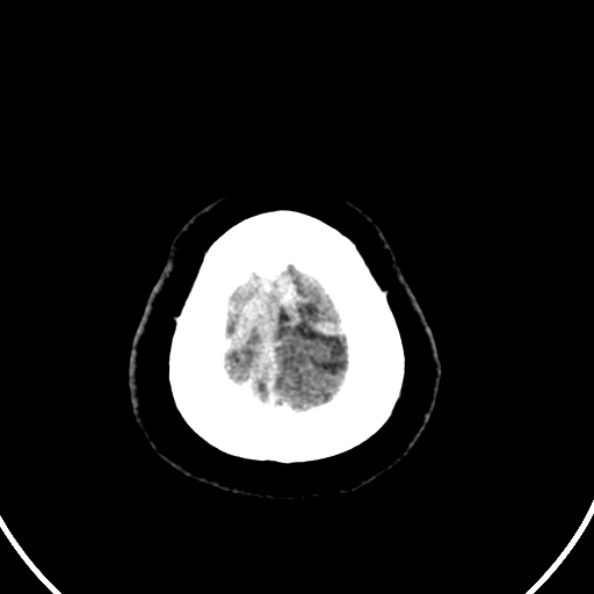 File:Cerebral venous hemorrhagic infarct from venous sinus thrombosis (Radiopaedia 55433-61883 Axial C+ delayed 12).jpg