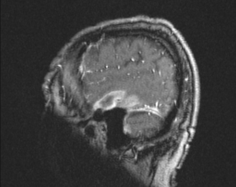 Cerebral venous infarction (Radiopaedia 65166-74176 Sagittal TOF 13).jpg