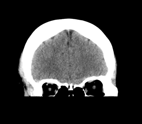 File:Cerebral venous infarction due to transverse sinus thrombosis (Radiopaedia 34688-36116 Coronal non-contrast 10).png