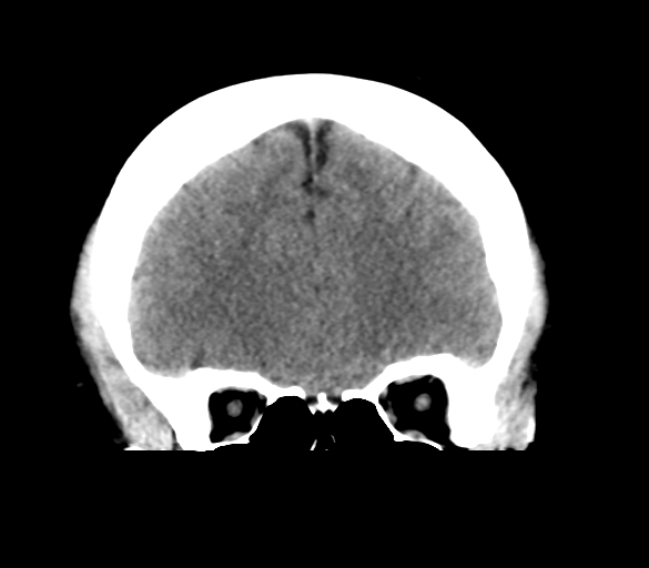 File:Cerebral venous infarction due to transverse sinus thrombosis (Radiopaedia 34688-36116 Coronal non-contrast 11).png