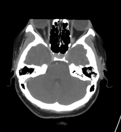 Cerebral venous infarction due to transverse sinus thrombosis (Radiopaedia 34688-36120 Axial CT venogram 16).png