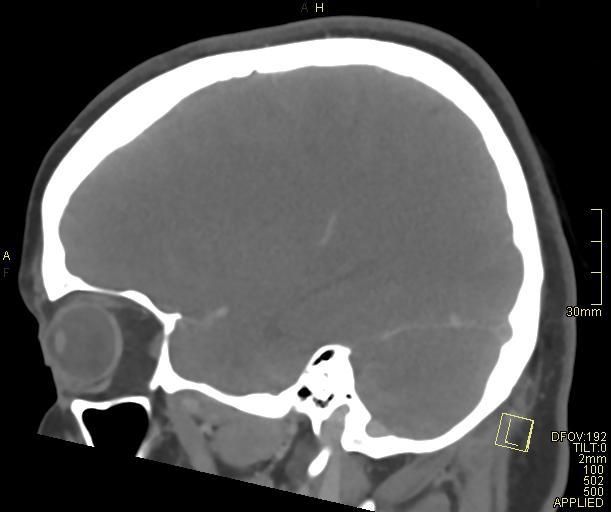 Cerebral venous sinus thrombosis (Radiopaedia 91329-108965 Sagittal venogram 23).jpg