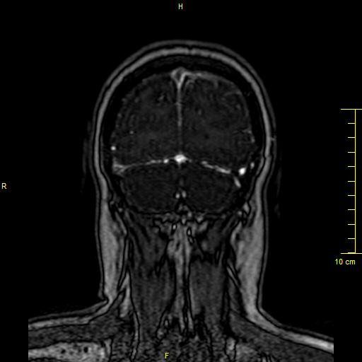 Cerebral venous thrombosis (Radiopaedia 23288-23351 MRV 153).JPG