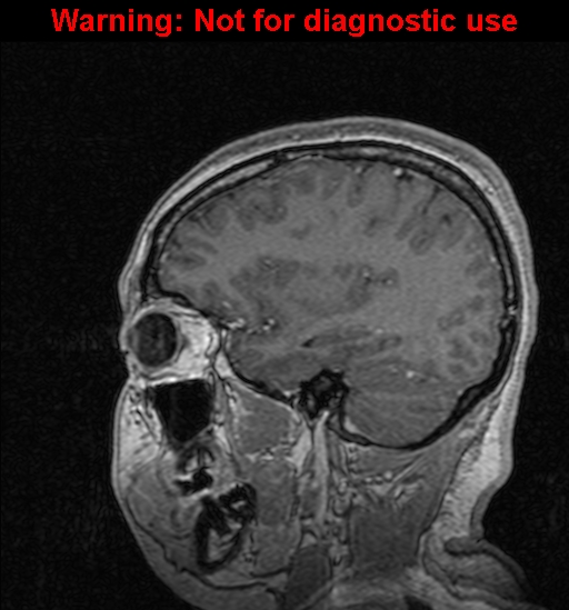 Cerebral venous thrombosis (Radiopaedia 37224-39208 Sagittal T1 C+ 44).jpg