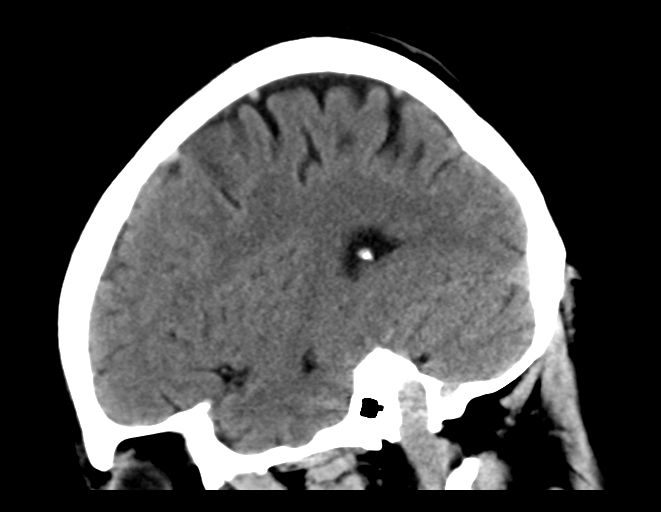 File:Cerebral venous thrombosis (Radiopaedia 38392-40467 C 10).png