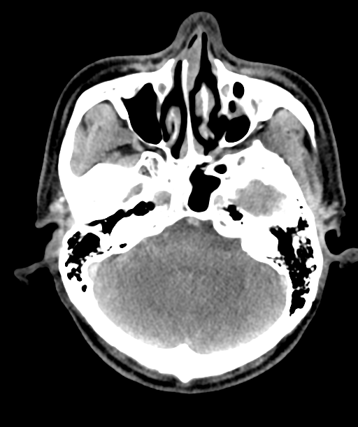 Cervical abscess (Radiopaedia 43725-47184 A 3).png
