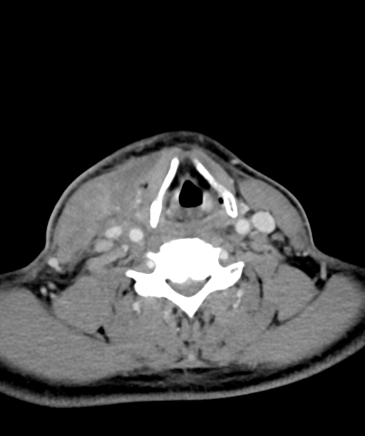 Cervical abscess (Radiopaedia 43725-47184 A 44).png