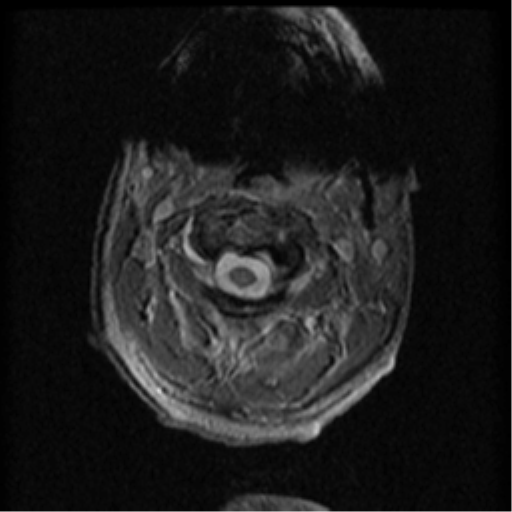 Cervical canal stenosis with cord compression (Radiopaedia 34114-35374 Axial Gradient Echo 83).png