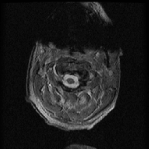 Cervical canal stenosis with cord compression (Radiopaedia 34114-35374 Axial Gradient Echo 85).png