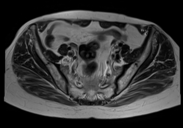 File:Cervical carcinoma (Radiopaedia 88312-104943 Sagittal T1 8).jpg