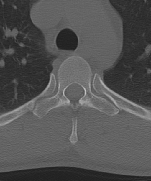 Cervical intercalary bone (Radiopaedia 35211-36748 Axial bone window 79).png
