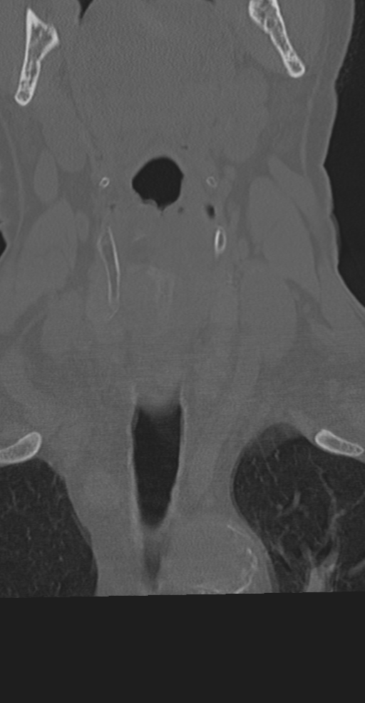 Cervical spine fracture in the setting of ankylosis (Radiopaedia 37038-38715 Coronal bone window 9).png