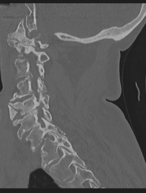 Cervical spondylolysis (Radiopaedia 49616-54811 Sagittal bone window 30).png