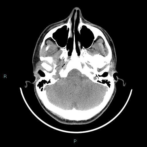 Cervical thymic cyst (Radiopaedia 88632-105335 Axial non-contrast 109).jpg