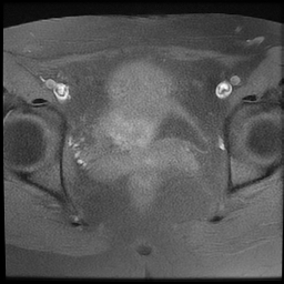 File:Cesarean scar ectopic pregnancy (Radiopaedia 77286-89362 Axial T1 fat sat 17).jpg