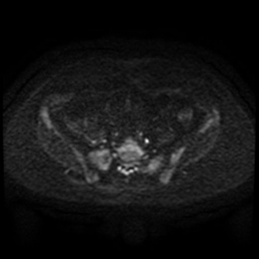 File:Cesarian section scar endometriosis (Radiopaedia 66520-75799 Axial DWI 78).jpg