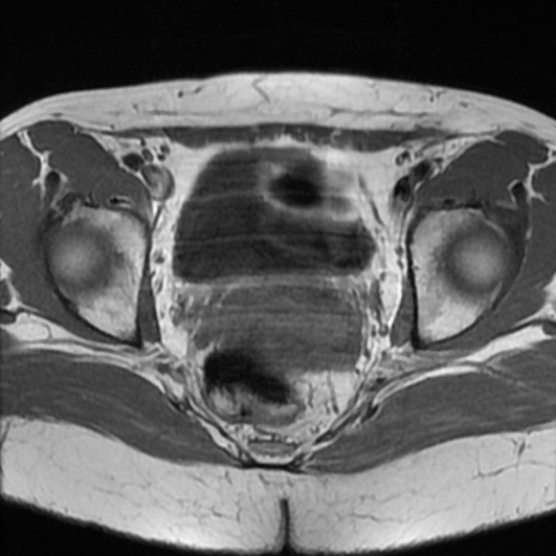File:Cesarian section scar endometriosis (Radiopaedia 66520-75799 Axial T1 15).jpg