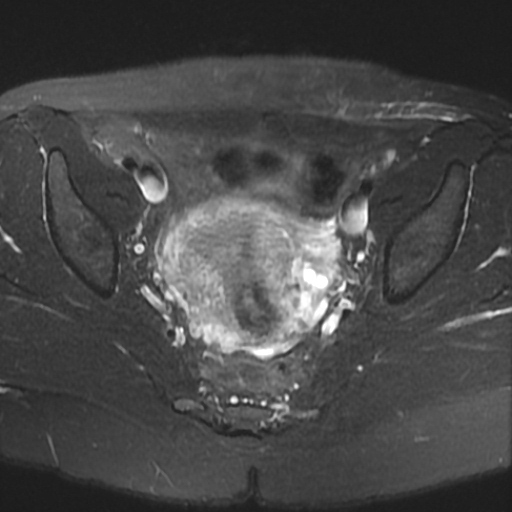 File:Cesarian section scar endometriosis (Radiopaedia 66520-75799 Axial T2 fat sat 12).jpg