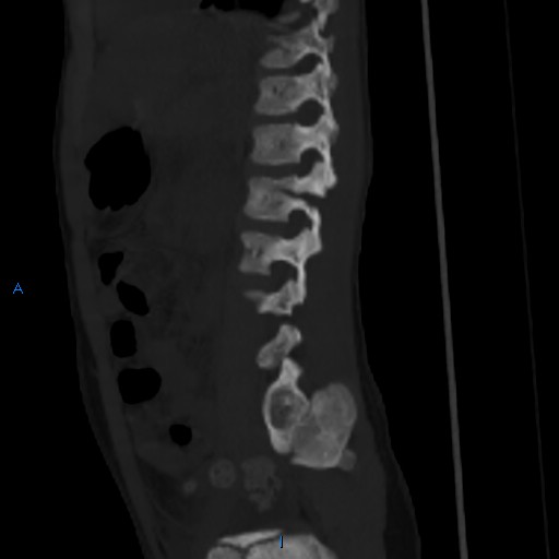 File:Chance fracture with duodenal and pancreatic lacerations (Radiopaedia 43477-50042 Sagittal bone window 4).jpg