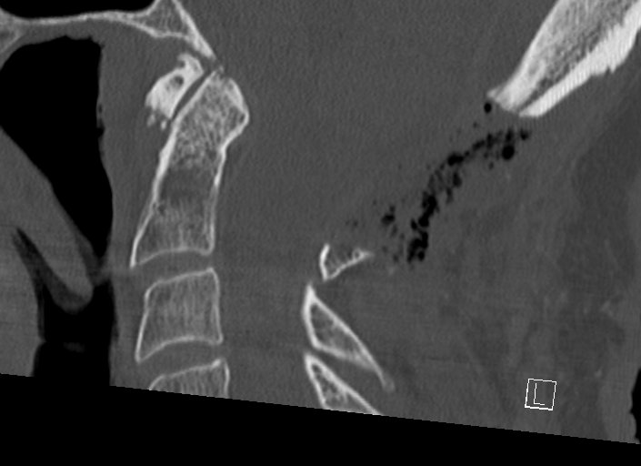 Chiari I malformation with a symptomatic syrinx of the posterolateral medulla oblongata (Radiopaedia 42573-45707 A 31).jpg