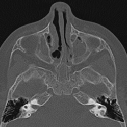 Choanal atresia (Radiopaedia 88525-105975 Axial bone window 45).jpg
