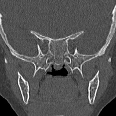 Choanal atresia (Radiopaedia 88525-105975 Coronal bone window 86).jpg