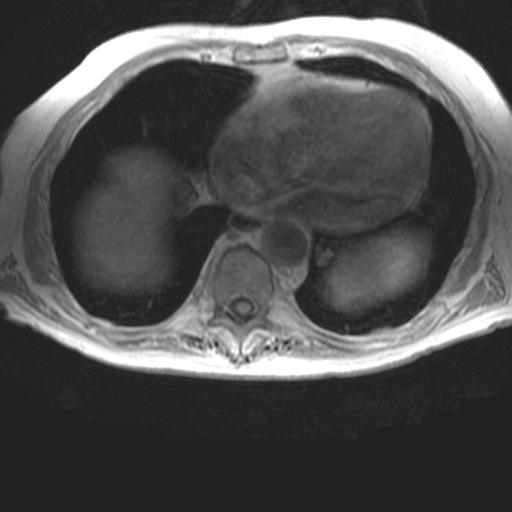 File:Cholangiocarcinoma - mass-forming pattern (Radiopaedia 16017-15677 T1 in-phase 1).jpg