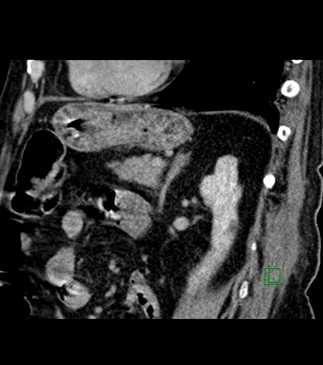 Cholangiocarcinoma with cerebral metastases (Radiopaedia 83519-98629 Sagittal C+ delayed 41).jpg