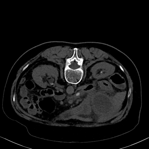 File:Cholecystitis - obstructive choledocholitiasis (CT intravenous cholangiography) (Radiopaedia 43966-47479 Axial 28).png