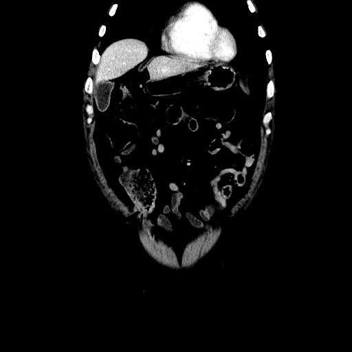 Choledocholiathiasis with normal caliber common bile duct (Radiopaedia 75368-86632 Coronal liver window 34).jpg