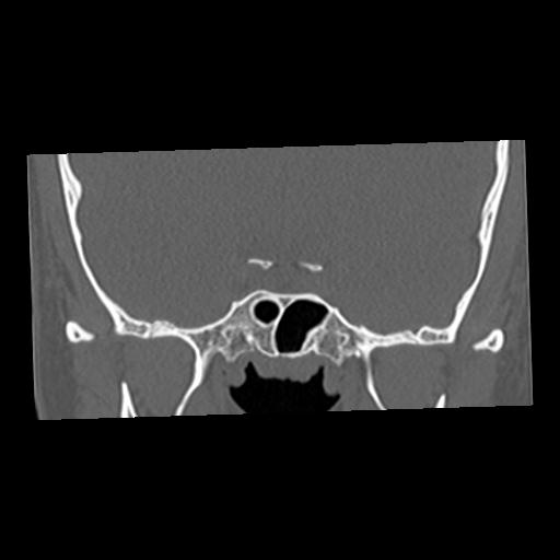 Cholesteatoma (Radiopaedia 84960-100474 Coronal bone window 9).jpg