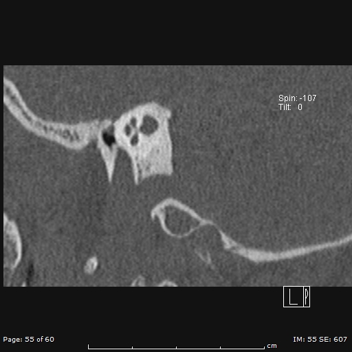 Cholesteatoma - external auditory canal (Radiopaedia 88452-105096 Sagittal bone window 55).jpg