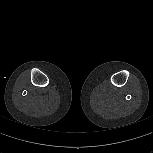 Chondroblastoma (Radiopaedia 62721-71030 Axial bone window 115).jpg