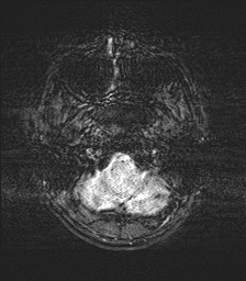 Chondrosarcoma - sphenoid wing (Radiopaedia 58259-67947 H 10).jpg