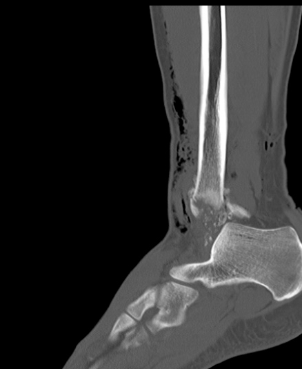 Chopart fracture (Radiopaedia 35347-36851 Sagittal bone window 44).jpg