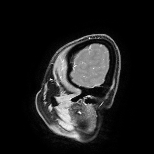 Chordoid glioma of third ventricle (Radiopaedia 91612-109340 F 30).jpg