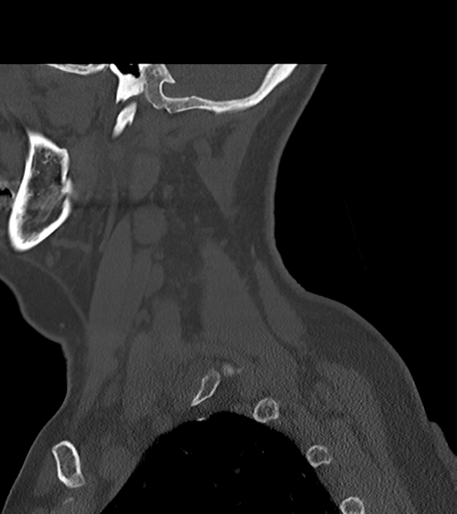 File:Chordoma (C4 vertebra) (Radiopaedia 47561-52188 Sagittal bone window 13).png