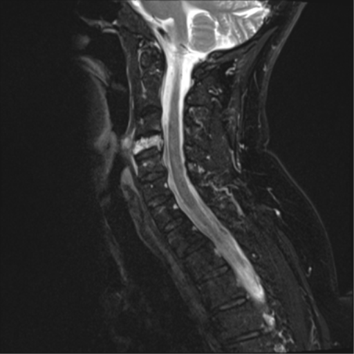 File:Chordoma (C4 vertebra) (Radiopaedia 47561-52189 Sagittal T2 fat sat 5).png