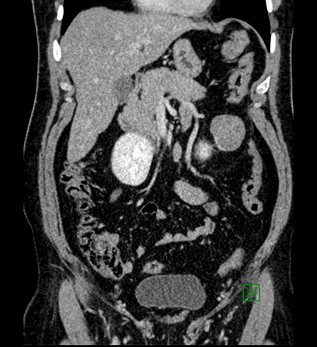 Chromophobe renal cell carcinoma (Radiopaedia 84286-99573 H 69).jpg