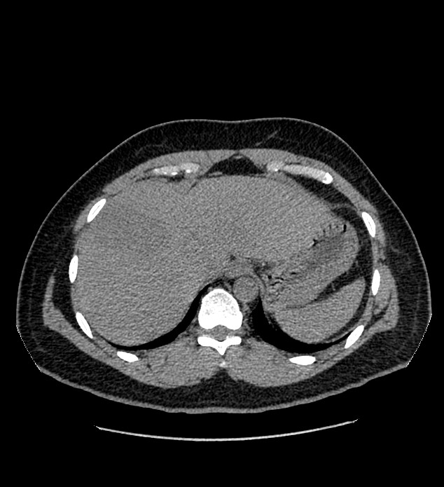 Chromophobe renal cell carcinoma (Radiopaedia 84337-99693 Axial non-contrast 11).jpg