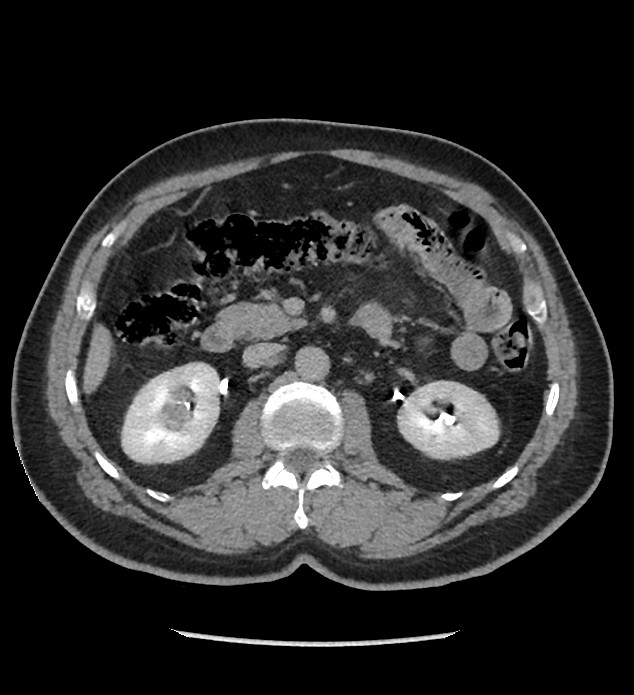 Chromophobe renal cell carcinoma (Radiopaedia 86879-103083 D 59).jpg