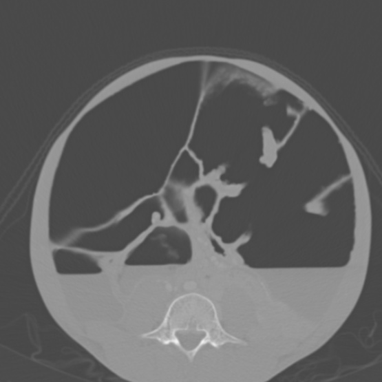 Chronic large bowel pseudo-obstruction (Radiopaedia 43181-46492 Axial bone window 110).jpg